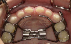 上あごの成長を促す方法