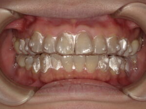 マウスピース矯正のなにが良い？